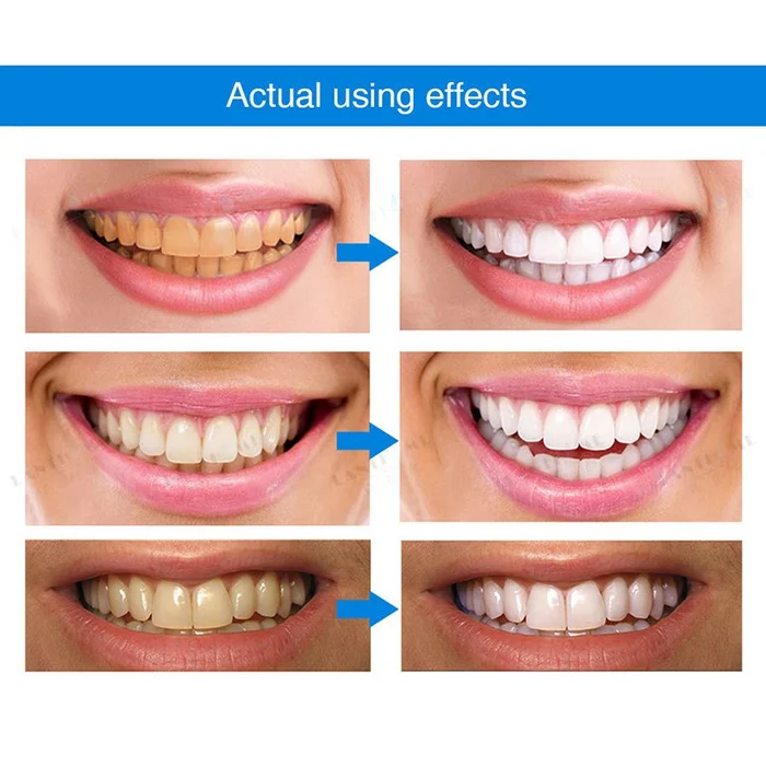 🦷Feelluckily ™ Teeth Whitening Pens